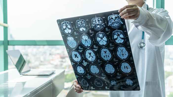 A droga deste Alzheimer reduz os sintomas em 30 %, diz um novo estudo