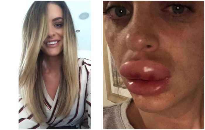 El procedimiento de relleno de labios fallido de la mujer se convierte en una pesadilla prolongada, se vuelve viral